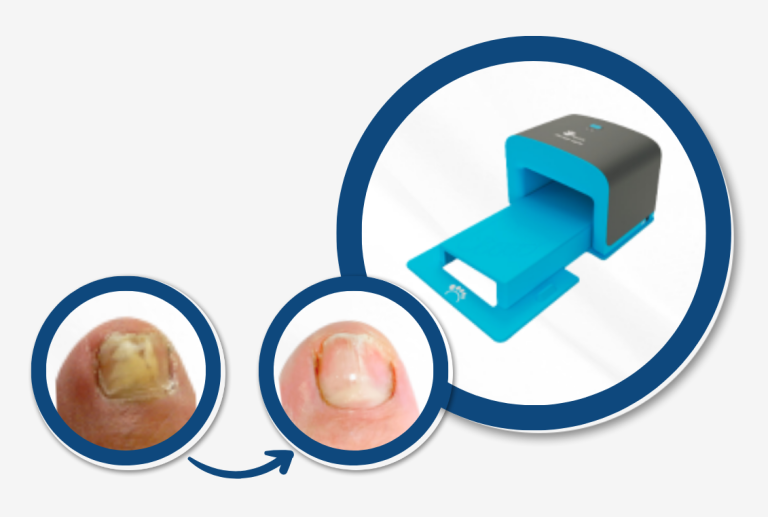 Before and after results of toenail fungus treatment with ToeFX light therapy device.