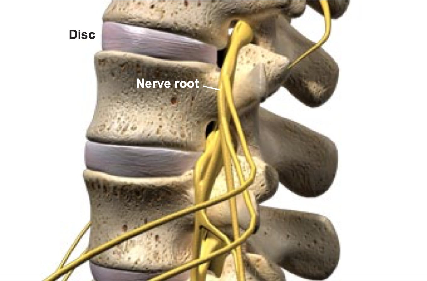 herniated-discs-1 Onero Logo
