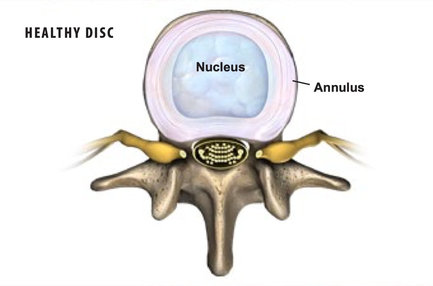 herniated-discs-2 Onero Logo