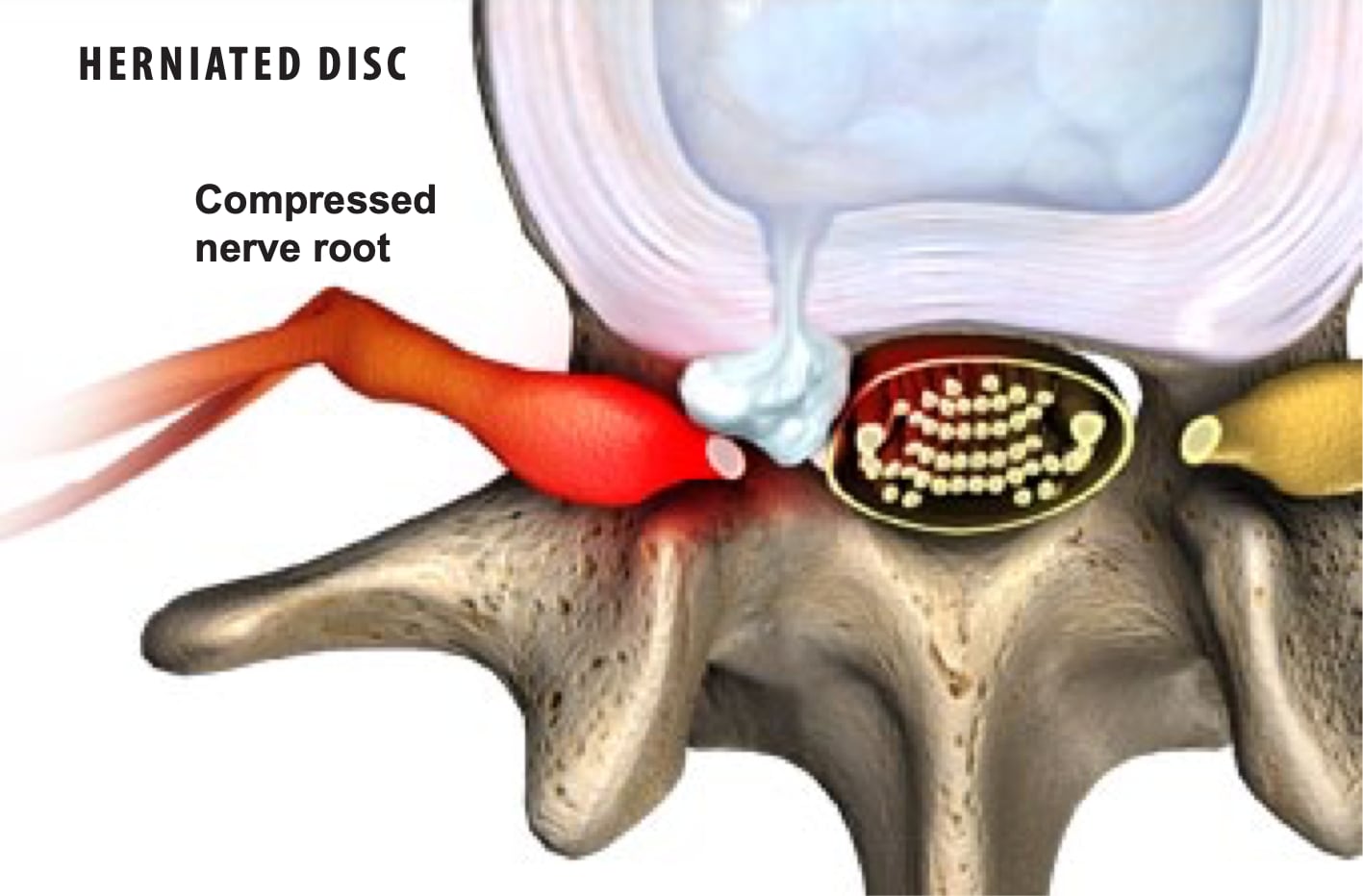 herniated-discs-3 Onero Logo